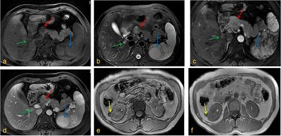 Tuberous Sclerosis Complex With Multiple Organ Tumors: Case Report and Literature Review